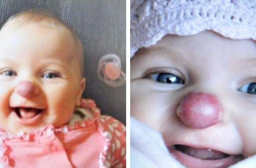  ¿Cómo luce ahora una niña que nació con “nariz de payaso”?