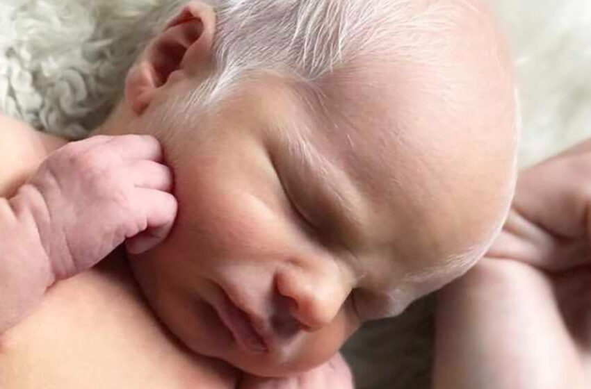  Bebé burlado por tener el pelo blanco: años después, luce perfectamente feliz y saludable