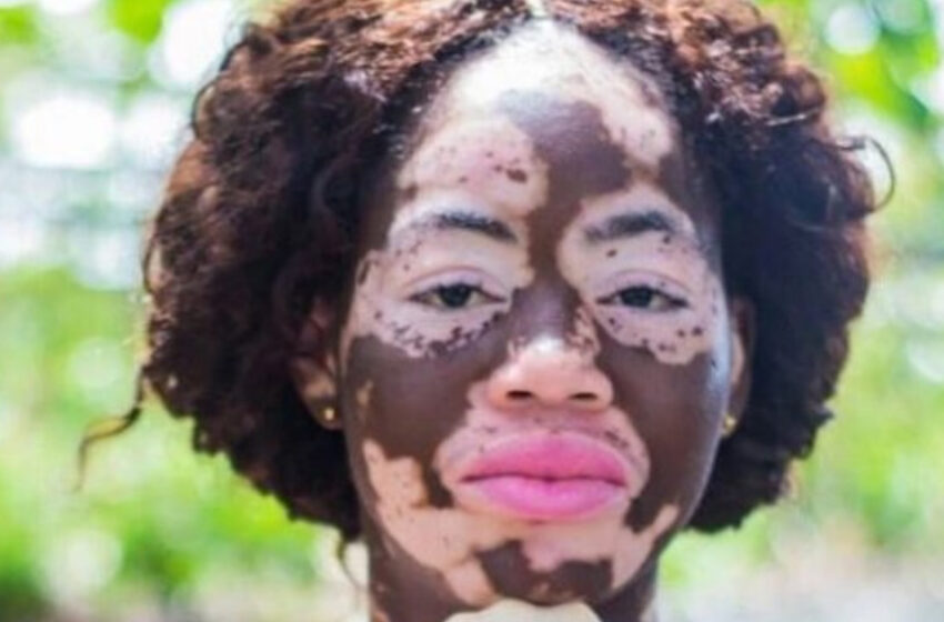  ¡La gente pensaba que le habían echado ácido! Cómo luce la chica con vitiligo de cuerpo entero