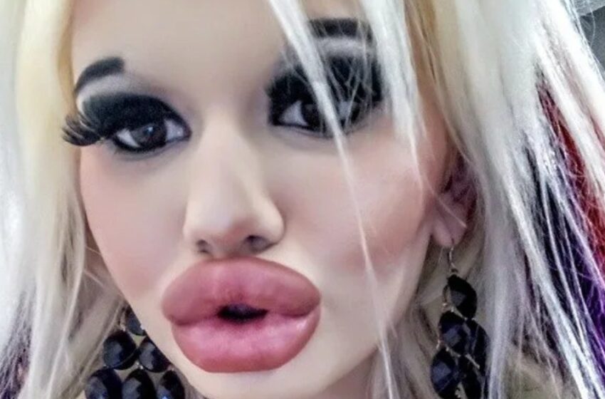  “Lips Occupy Most Of Her Face”: ¡La Chica Agrandó Sus Labios Pero Cometió Un Error Con El Tamaño!