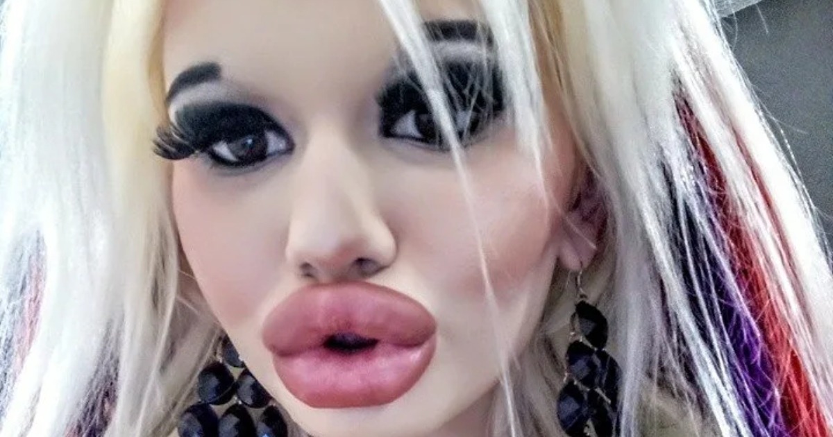 “Lips Occupy Most Of Her Face”: ¡La Chica Agrandó Sus Labios Pero Cometió Un Error Con El Tamaño!