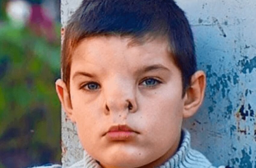 Un niño nacido con una rara condición nasal se sometió a cirugía: ¿Cómo luce ahora?