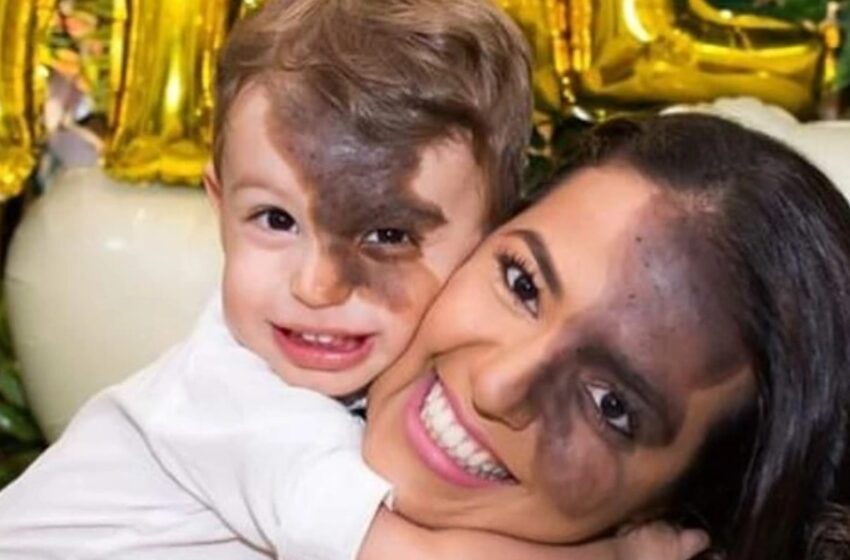  “No quería que mi hijo se sintiera diferente”: Una madre obtuvo una réplica de la marca de nacimiento oscura de su hijo para que el niño no se sintiera avergonzado de su rostro