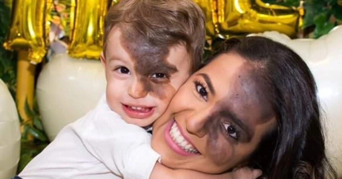 “No quería que mi hijo se sintiera diferente”: Una madre obtuvo una réplica de la marca de nacimiento oscura de su hijo para que el niño no se sintiera avergonzado de su rostro