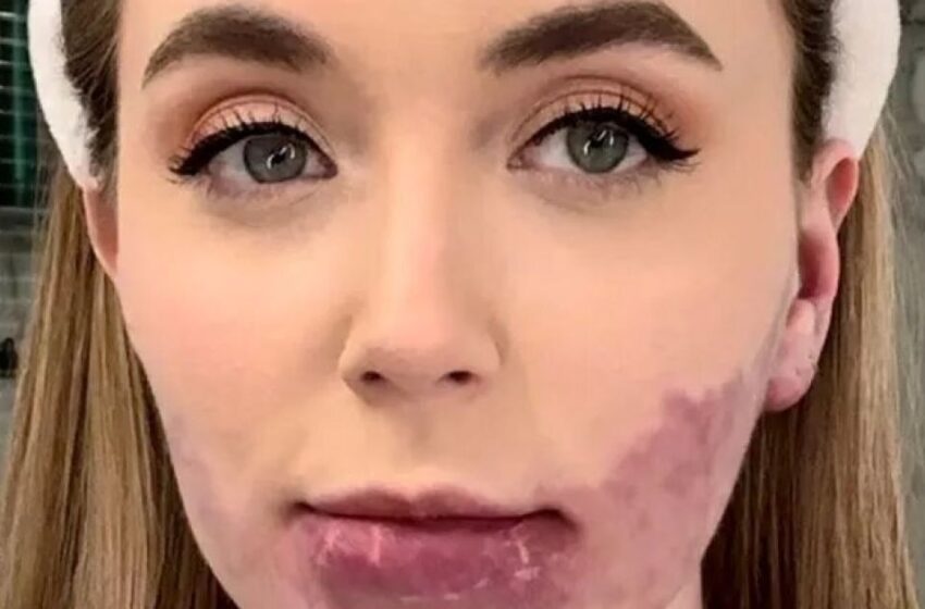 “Tenía una gran marca de nacimiento en la cara”: ¿Cómo se ve la chica después de 20 cirugías faciales para eliminar una marca de nacimiento?