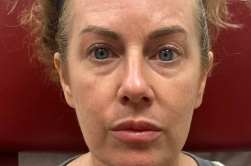 Una mujer soñó con recuperar su aspecto juvenil: ¡El resultado del procedimiento de Botox la impresionó mucho!