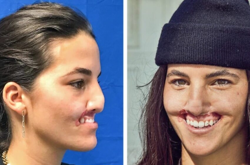 Una modelo perdió su belleza debido al perro que le destrozó el rostro: ¿Cuál fue el camino de la chica hacia una nueva apariencia?