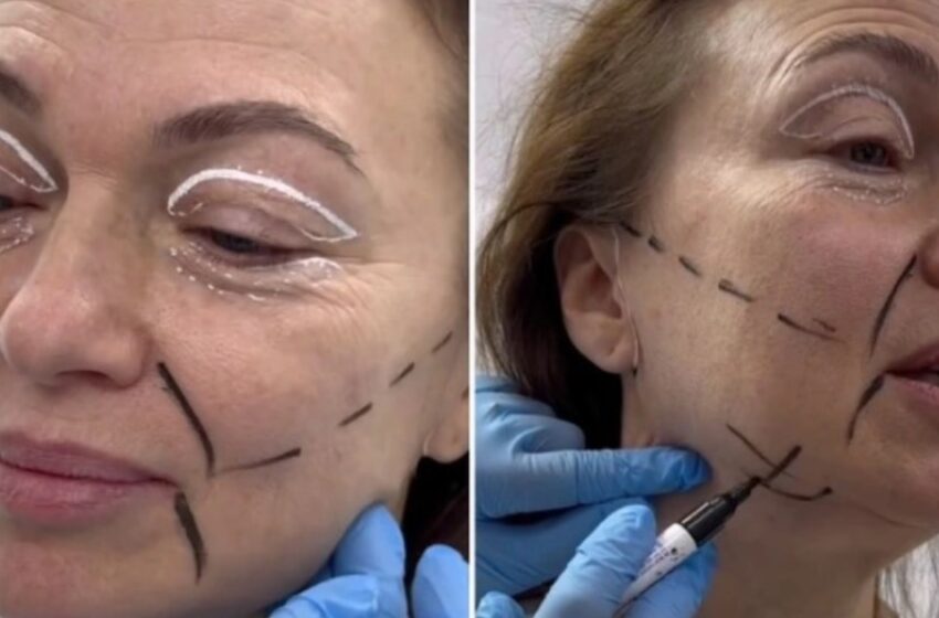  Una mujer de 58 años sorprendió a todos con los resultados de su cirugía de lifting facial: ¡incluso está considerando actualizar su pasaporte!