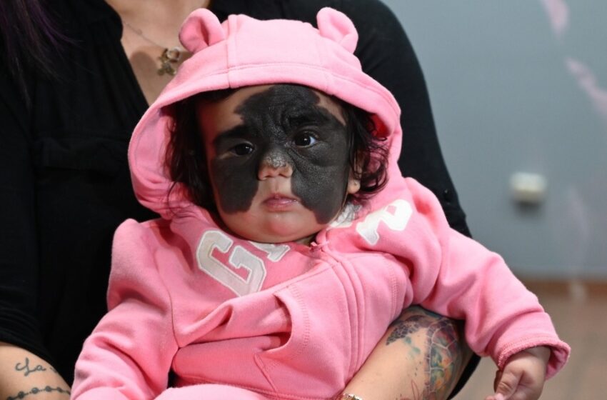 “No quedará ninguna marca en su rostro”: ¿Cómo luce la niña con la “máscara de Batman” después de la cirugía?