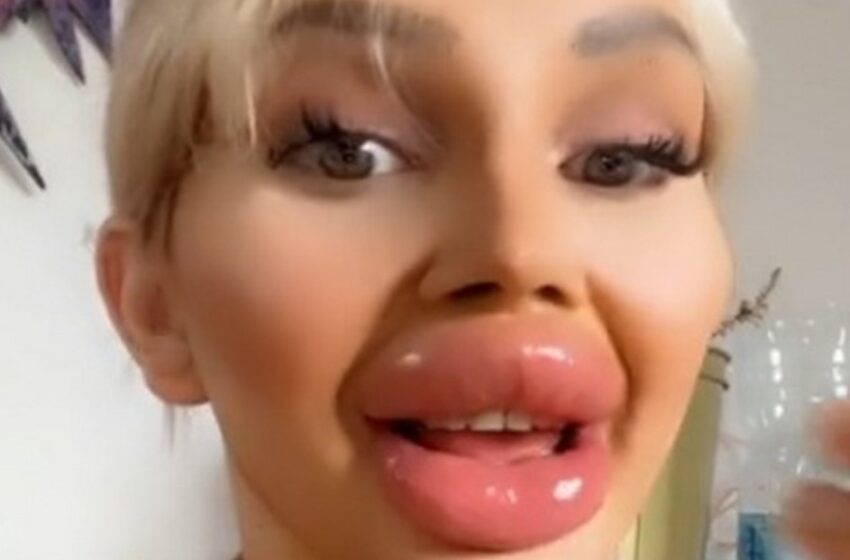 “¡Terrorífica ‘belleza’!”: ¿Cómo luce la chica con 1 onza de relleno en los labios?