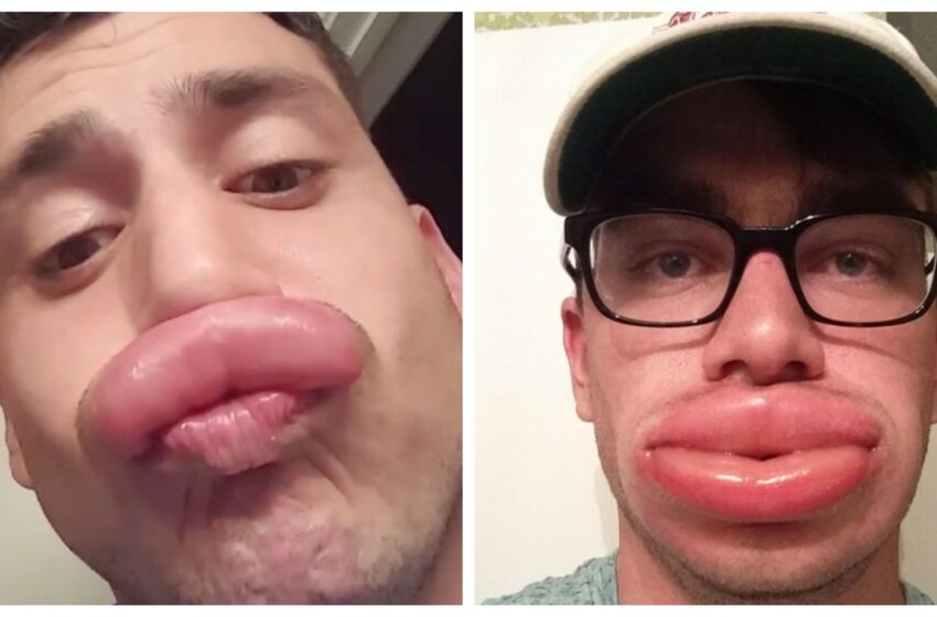  “¡Picaduras de abeja en lugar de botox!”: 11 fotos hilarantes de abejas ayudando a las personas a obtener “labios de pato”.