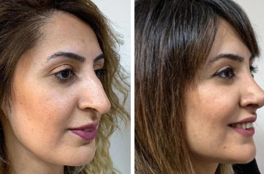 10 Mujeres Que Demostraron Que Un Pequeño Cambio en la Nariz Puede Hacer Una Gran Diferencia: ¡Fotos Increíbles de Antes y Después!