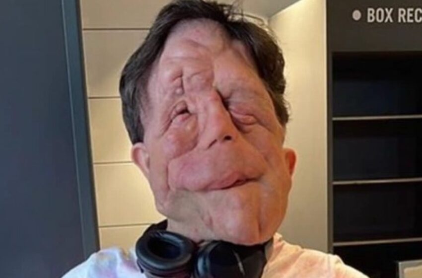 “Historia inspiradora de Adam Pearson”: ¡Cómo el hombre con una apariencia ‘única’ superó su condición y se convirtió en un modelo a seguir!