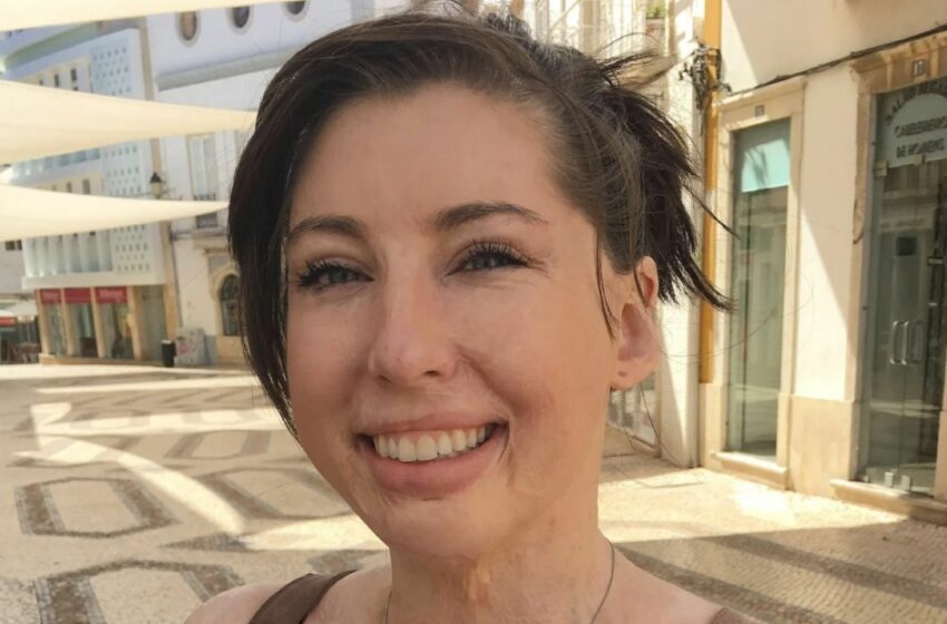 “¡Ella Luce Trajes de Baño con Orgullo a Pesar de las Numerosas Cicatrices en su Cuerpo!”: Fotos Reveladoras de la Mujer con Quemaduras en el 96% de su Cuerpo.