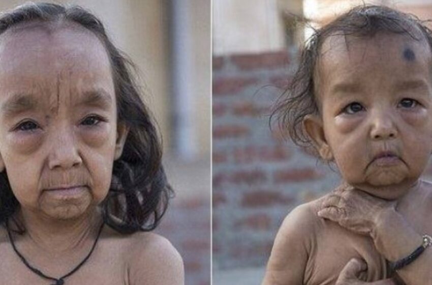 “Hermano y hermana de India parecen ‘pequeños ancianos’: ¡La terrible historia de los hermanos!”