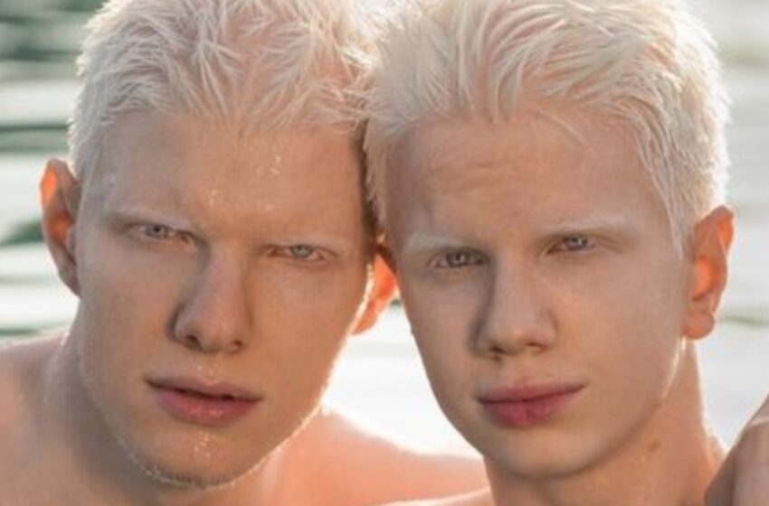  ¿Cómo Luce La Madre De Estos Hermanos Albinos?: “Familia Inusual”