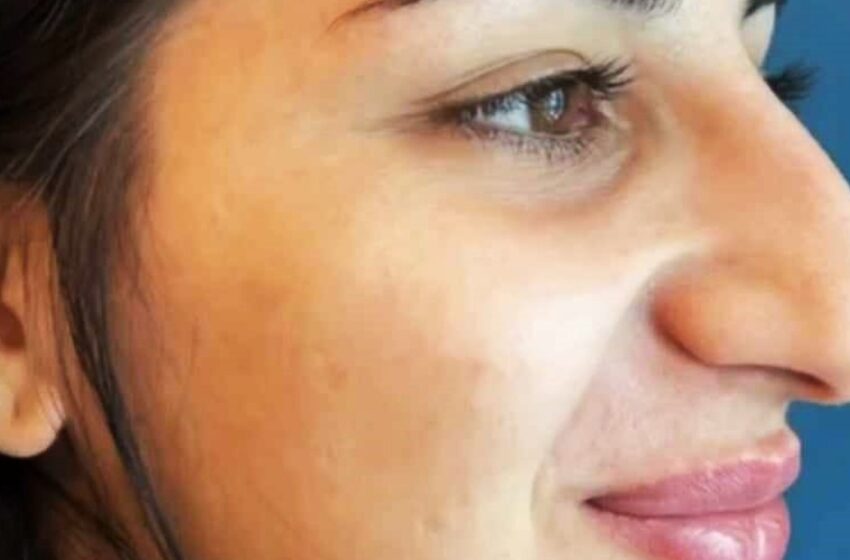  “Transformación Irreconocible”: ¡Cómo la Rinoplastia de la Chica Atrajo a Incontables Admiradores!