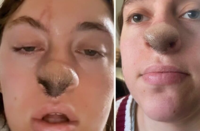 ¡Mordedura de perro provoca el crecimiento de vello en la nariz de una mujer: ¡La foto revela las impactantes secuelas!