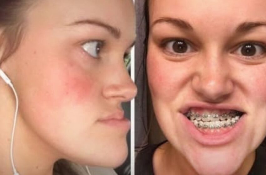 ¡Mujer que “odiaba mirarse en el espejo” después de una cirugía doble de mandíbula revela su nuevo aspecto! ¿Cómo luce ahora?