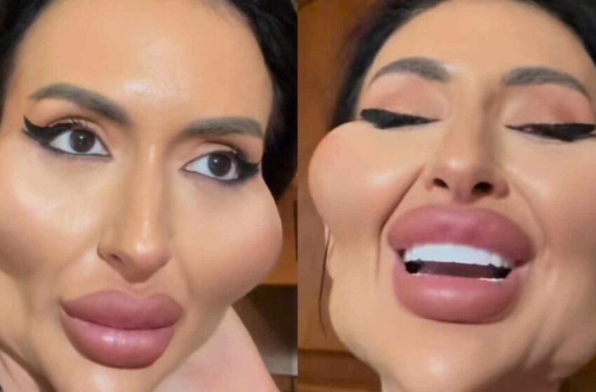  ¡Mujer con pómulos prominentes se hace un levantamiento de glúteos!: ¡A su mamá le encantan los resultados!