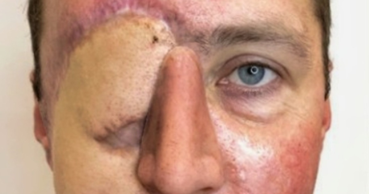 ¡Tras perder un ojo en un accidente de coche, este hombre permitió que un tatuador rediseñara su rostro! ¡El resultado es simplemente increíble!