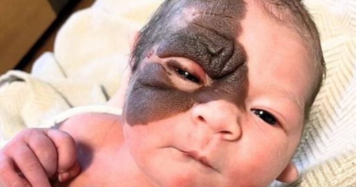 Nacida con una marca única, la increíble transformación de esta valiente niña te derretirá el corazón: ¡mira sus fotos!