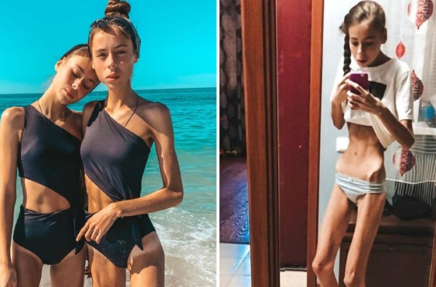  Pesaban solo 38 kg y casi murieron, ¡pero lo superaron! ¿Cómo lucen ahora?
