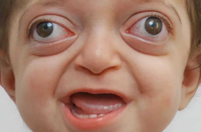 ¡Los médicos transforman el rostro inusual de un niño!: ¡Mira su aspecto sorprendente después de todos los cambios!