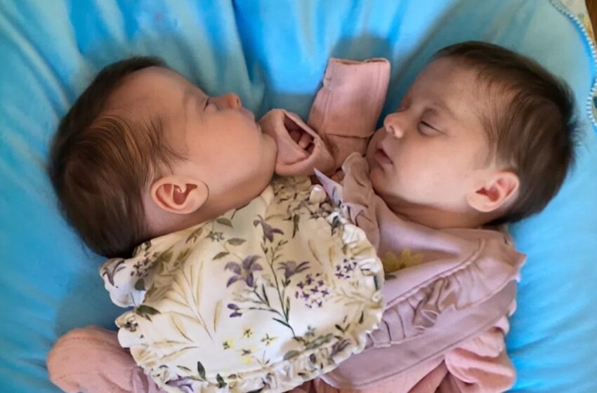  De unidas por el pecho a niños llenos de vida: así están las gemelas separadas 3 años después —Mira sus fotos