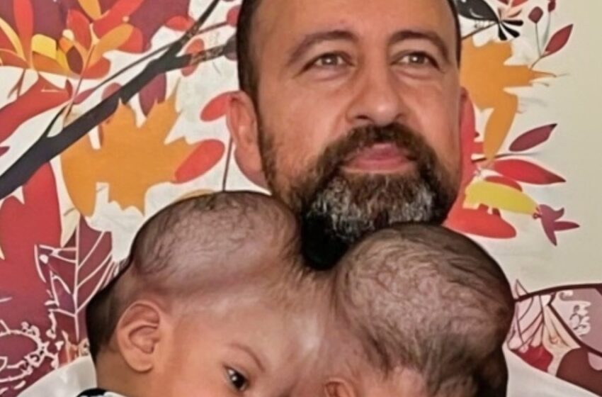  ¡El increíble viaje de los gemelos siameses que compartían tejido cerebral tras una arriesgada cirugía!: ¡Mira cómo lucen ahora!
