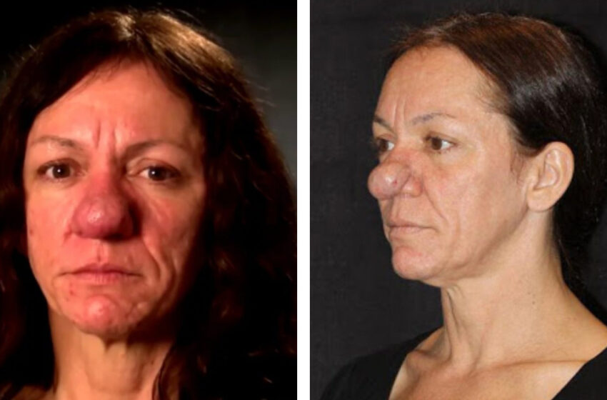 «¡Se ha convertido en una verdadera belleza!»: una mujer que nació con una nariz grande debido a una rara enfermedad decidió someterse a una cirugía plástica.