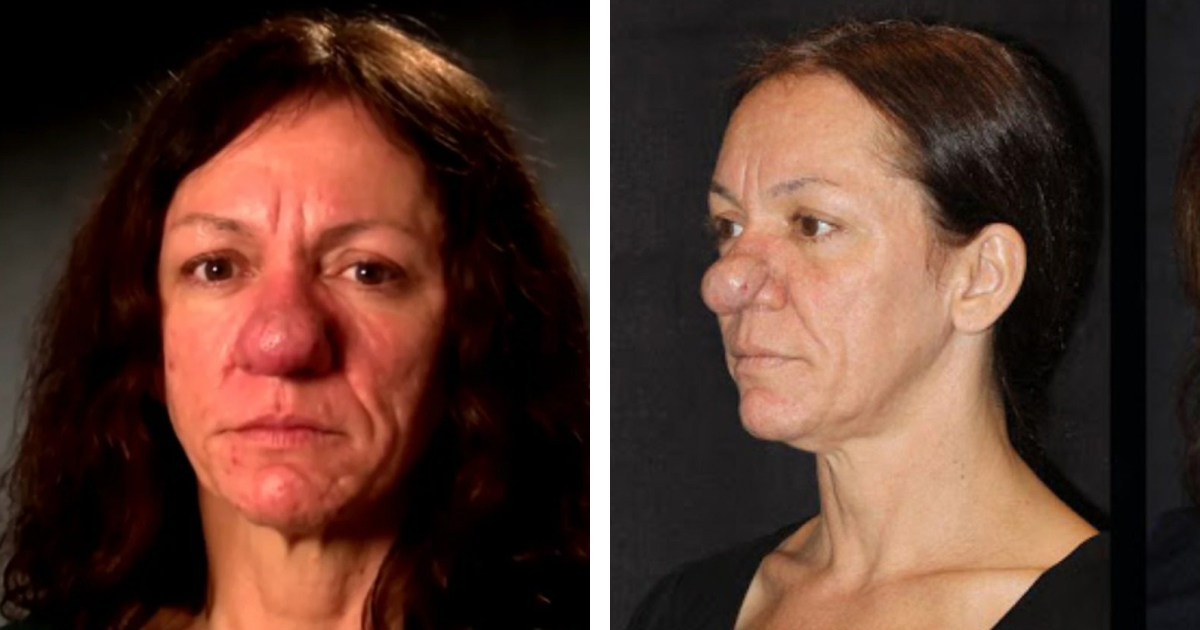 «¡Se ha convertido en una verdadera belleza!»: una mujer que nació con una nariz grande debido a una rara enfermedad decidió someterse a una cirugía plástica.