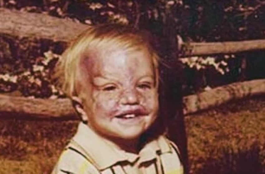¡Un niño pequeño sobrevive a horribles quemaduras e inspira con su transformación! ¡Mira las fotos!