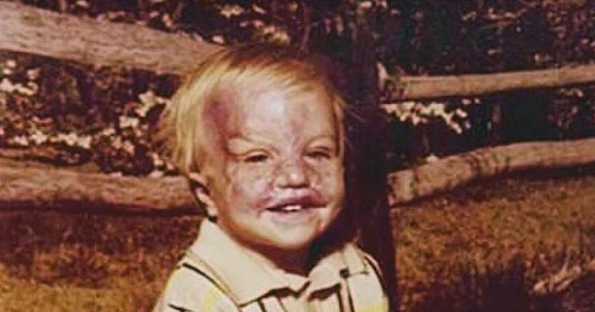 ¡Un niño pequeño sobrevive a horribles quemaduras e inspira con su transformación! ¡Mira las fotos!