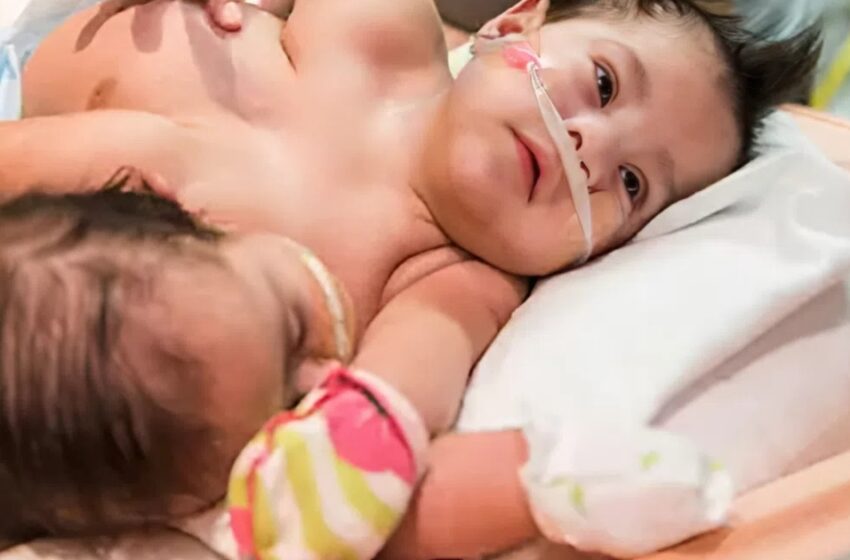  ¡La increíble historia de los gemelos siameses que vencieron las probabilidades!: ¿Cómo se ven ahora?