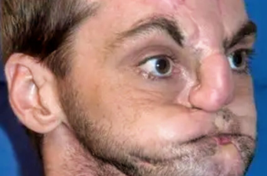  ¡Su rostro quedó destrozado hasta que una cirugía revolucionaria le devolvió la esperanza! ¡Mira las fotos!